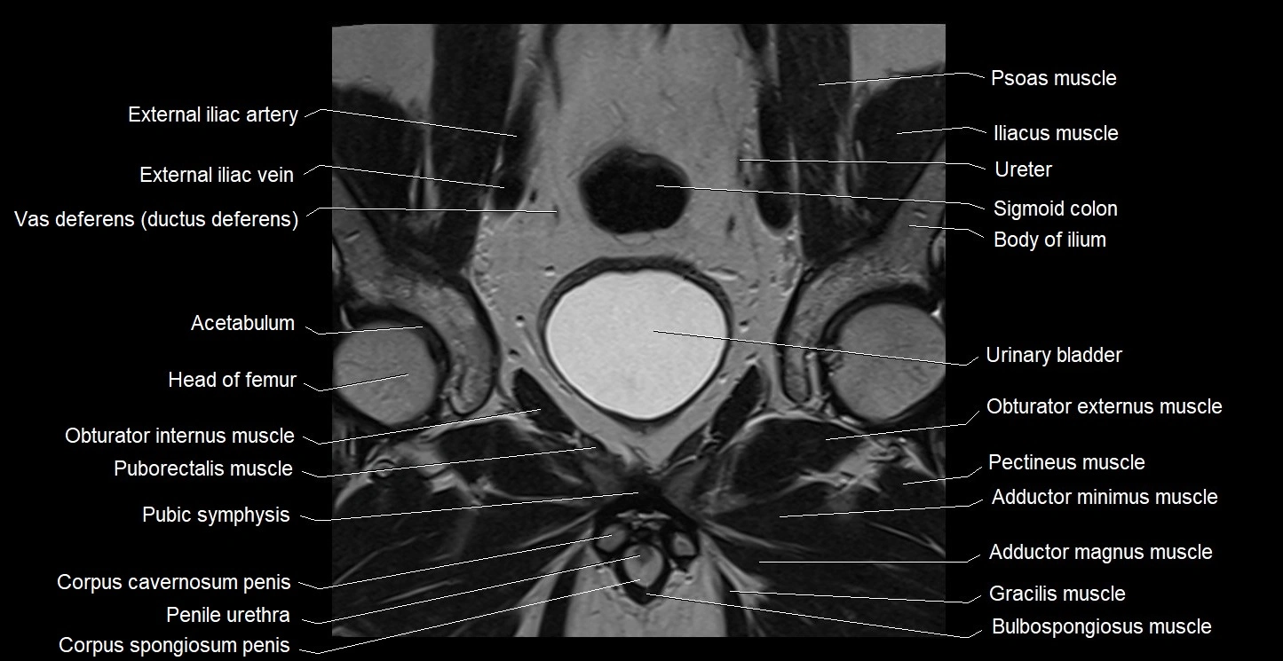 MRI coronal cross sectional anatomy male pelvis image 16.webp